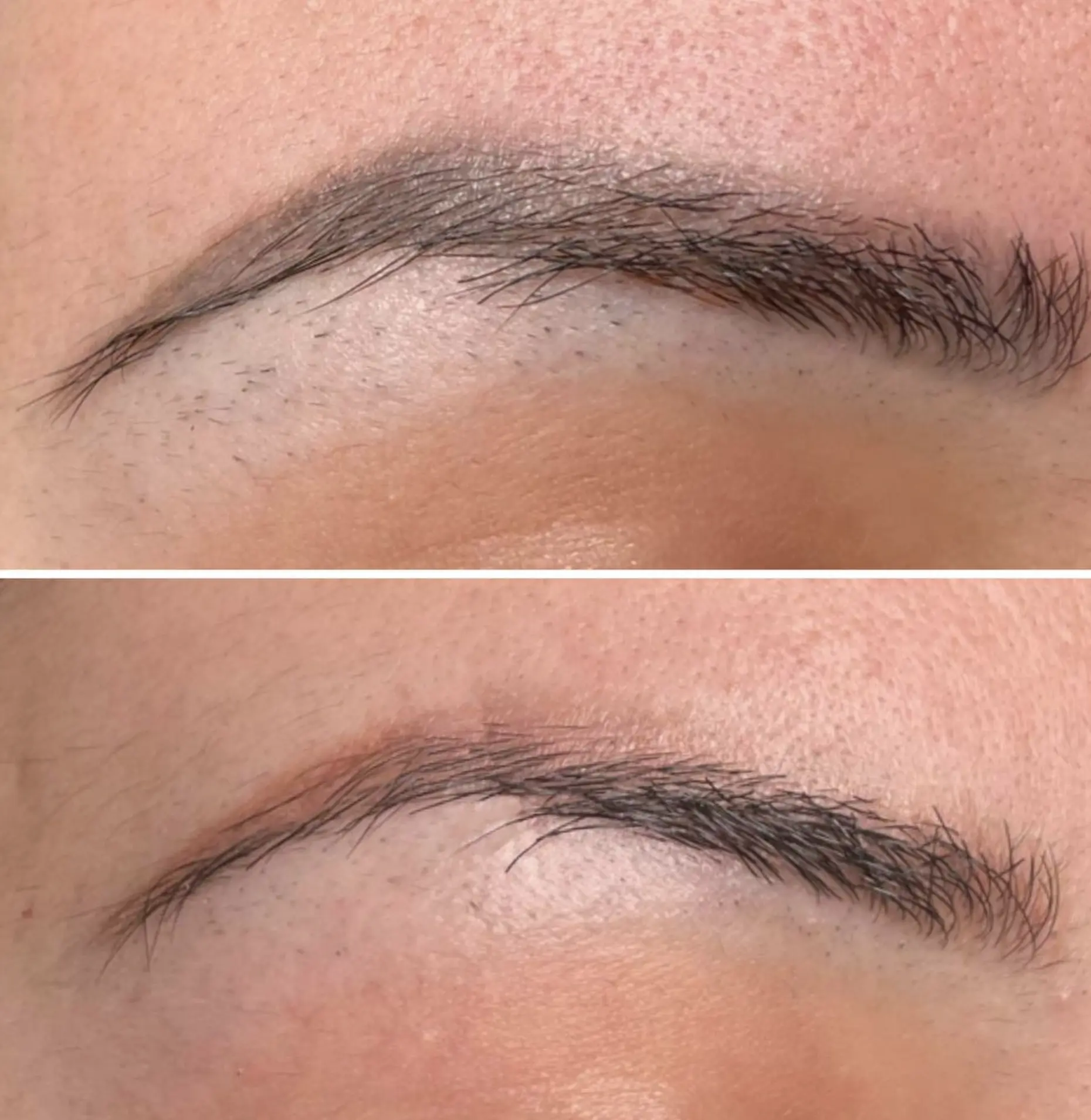 laser eyebrow tattoo removal