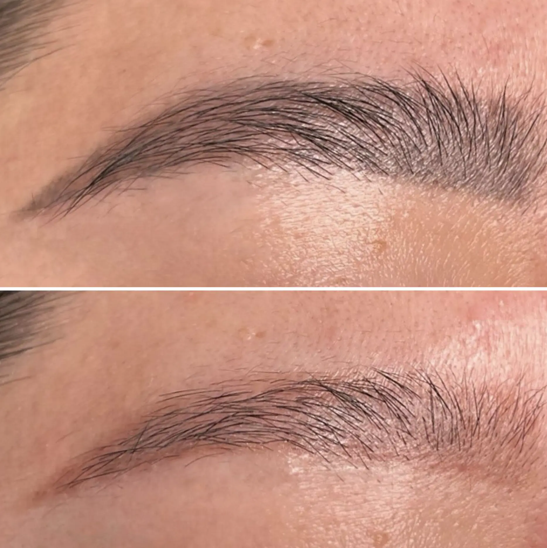 laser tattoo removal