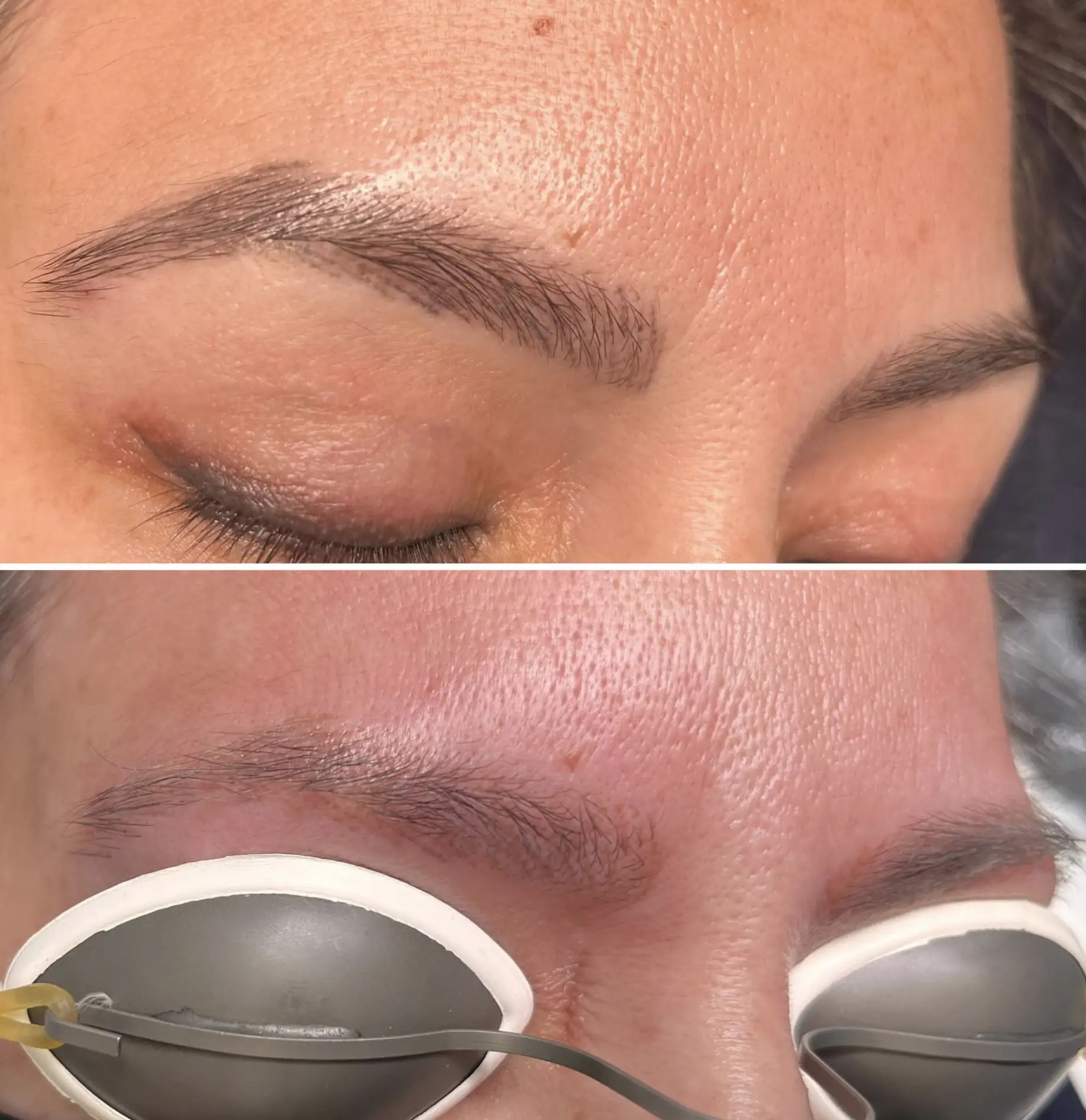 laser tattoo treatment in Melbourne